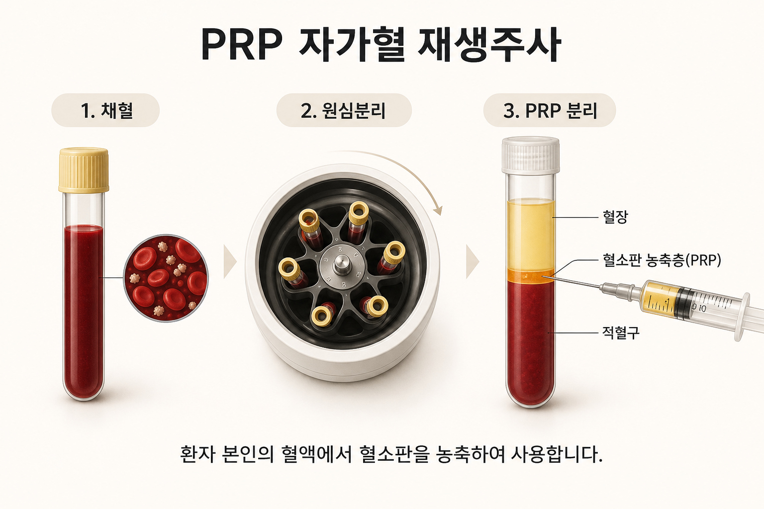 재생주사, PRP 자가혈 줄기세포 주사